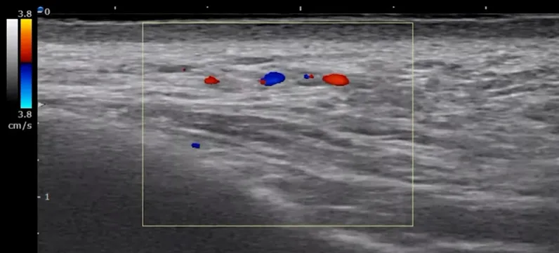 Doppler ultrasound image showing blood flow in facial vessels