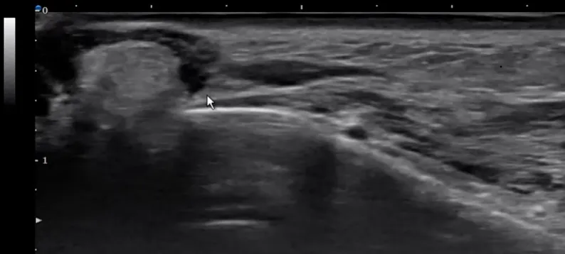 Ultrasound image showing the skin, fat, and SMAS layers