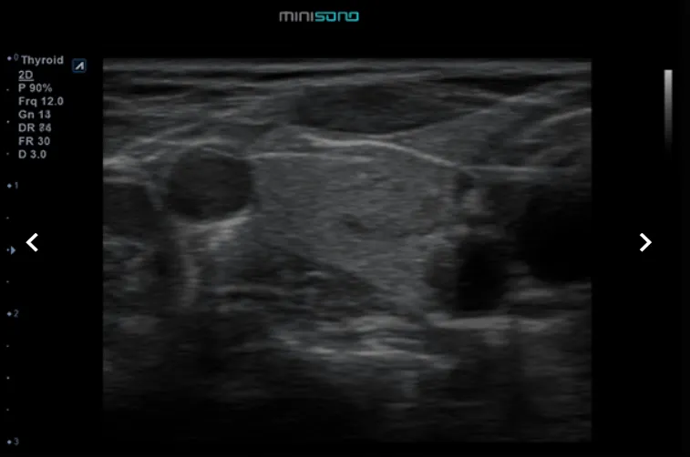 Korean facial treatment — Portable & Console Diagnostic Ultrasound ultrasound image