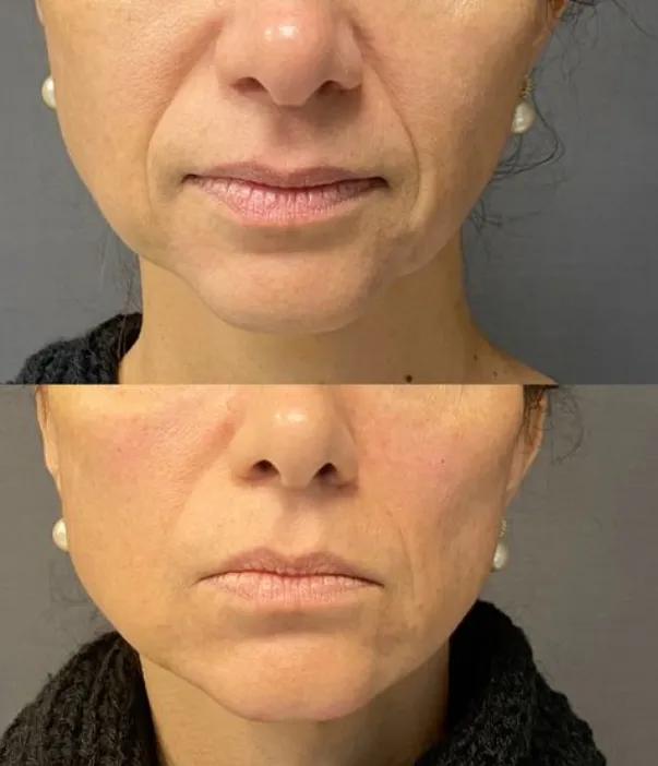 Korean facial treatment — Before and after Filler