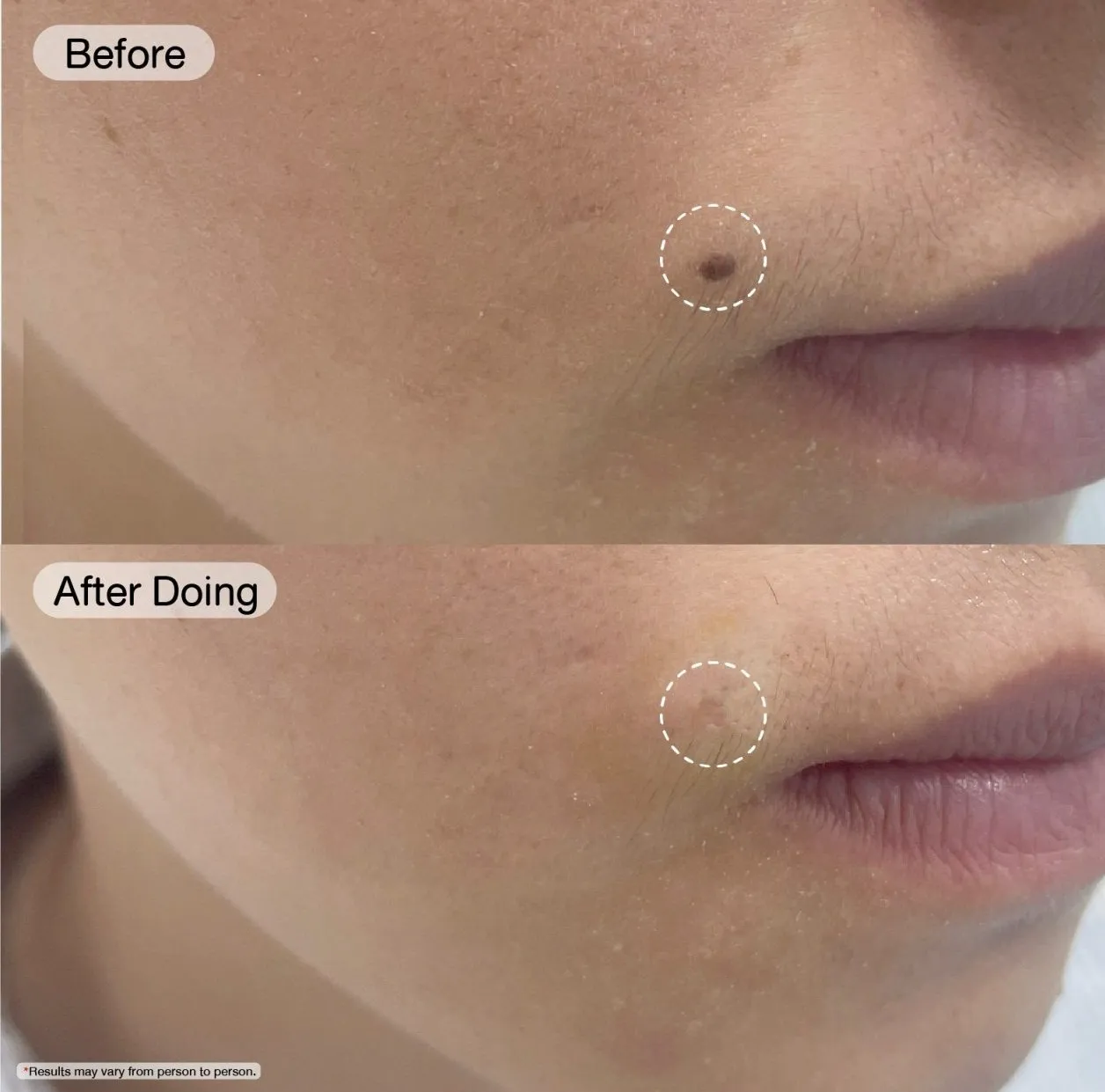 Korean facial treatment — Mole removal with the CO2 laser, before and after