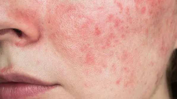 Korean facial treatment — Skin concern treated with Excel V