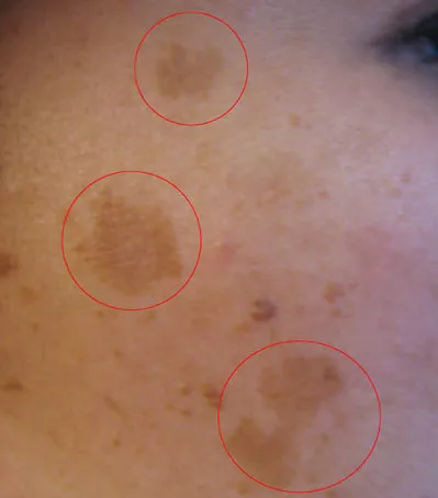 Korean facial treatment — Pigmented lesions on the cheek