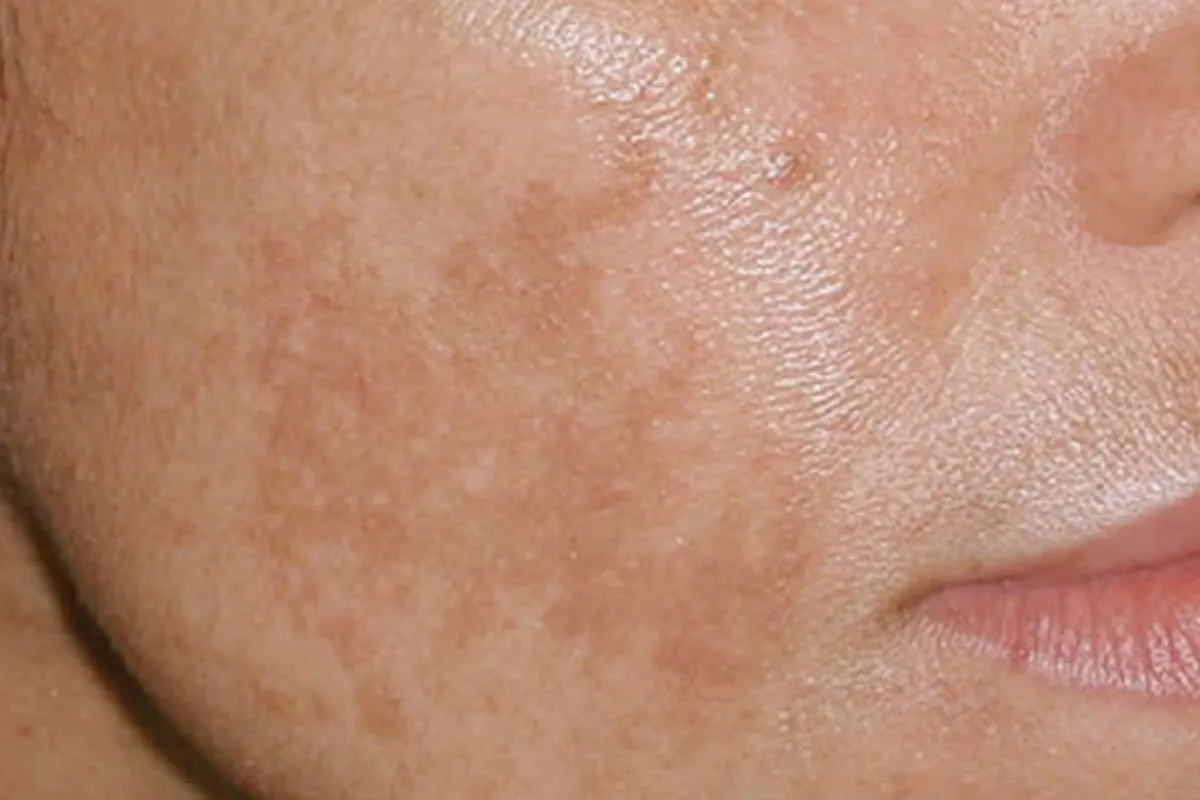 Korean facial treatment — Melasma spread across the cheek