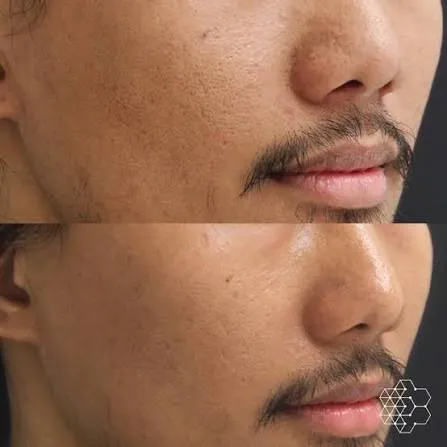 Korean facial treatment — Before and after Re2o