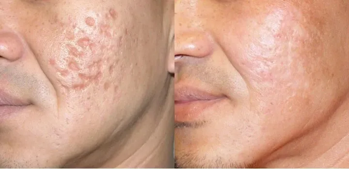 Korean facial treatment — Acne scars treated with fractional CO2, before and after