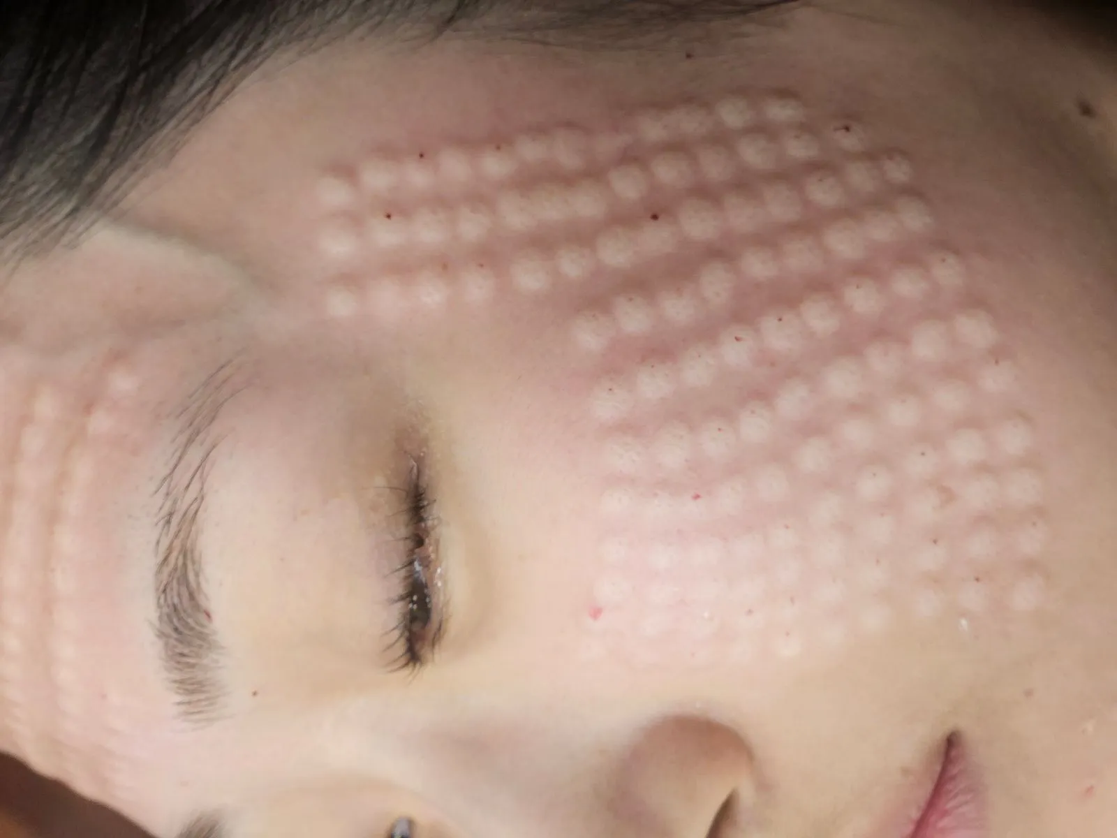 Korean facial treatment — Skin immediately after Rejuran (1)