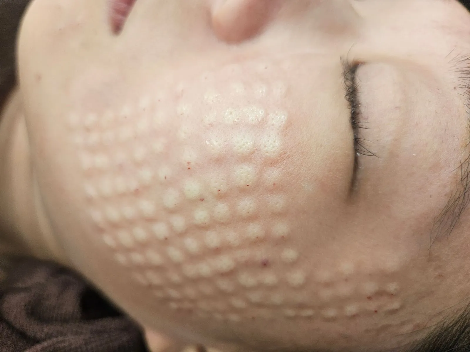 Korean facial treatment — Skin immediately after Rejuran (2)
