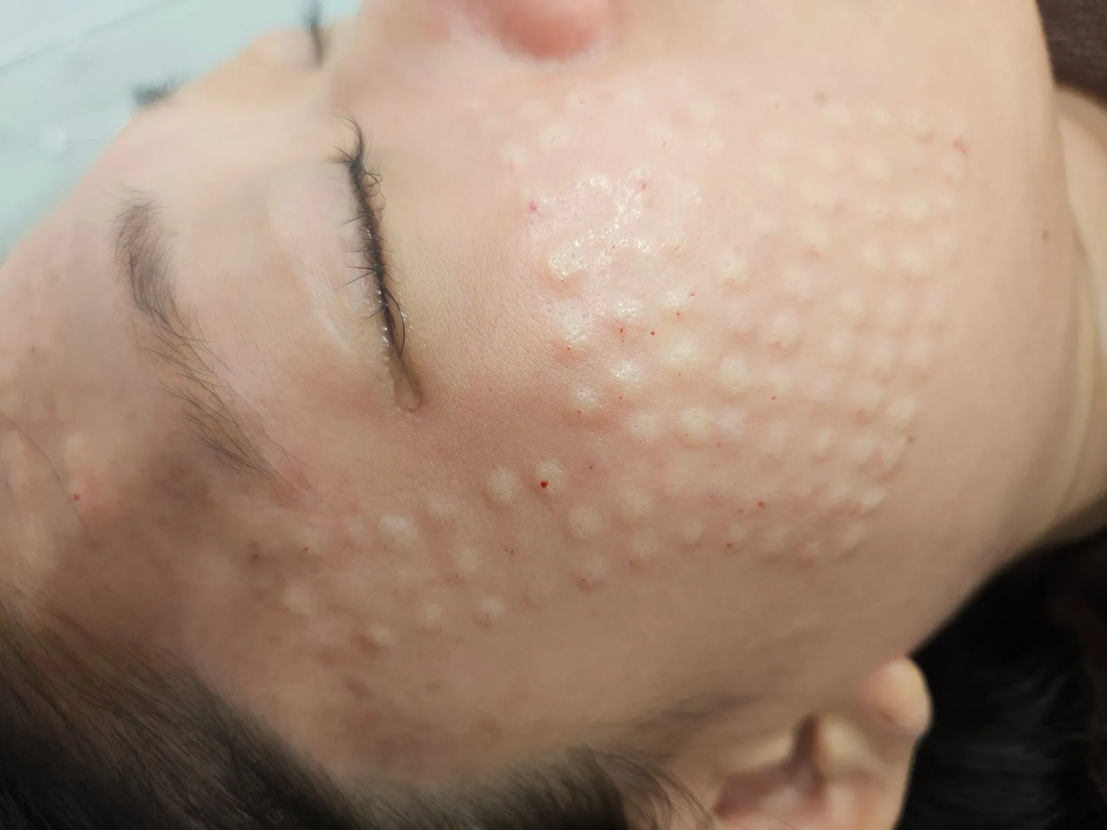 Korean facial treatment — Skin immediately after Rejuran (3)