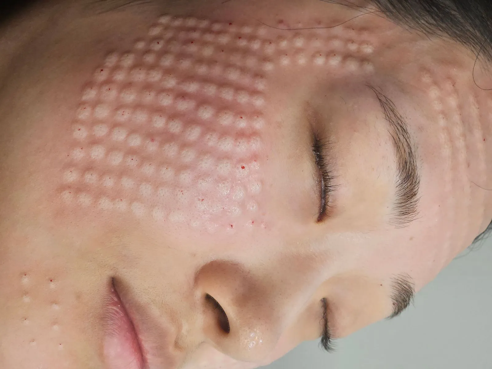 Korean facial treatment — Skin immediately after Rejuran (4)