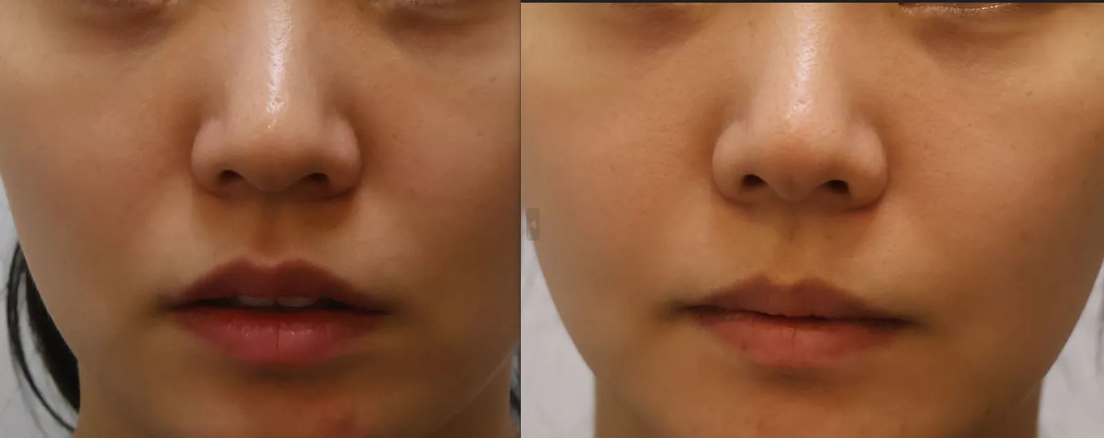 Korean facial treatment — Before and after Juvelook Volume