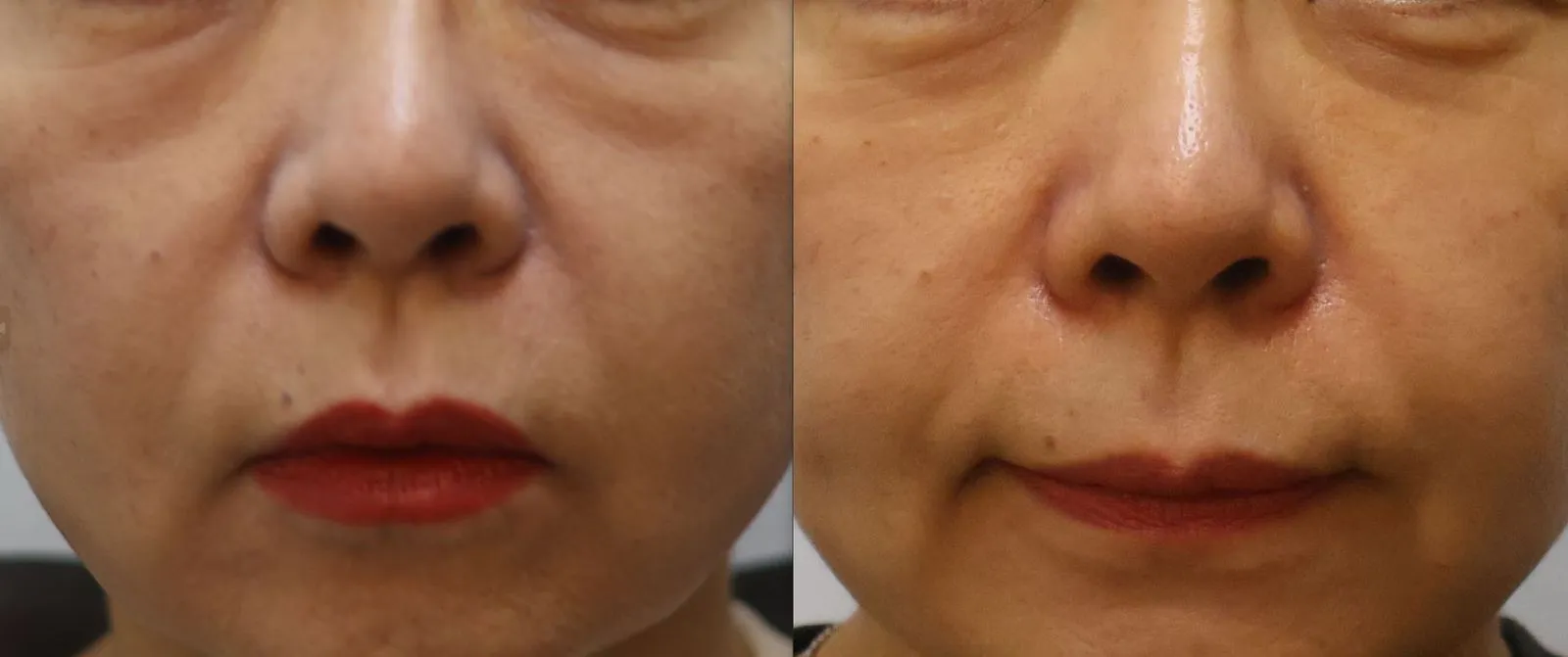 Korean facial treatment — Before and after Juvelook Eye
